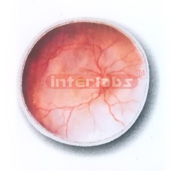 POSTERIOR PART OF THE EYEBALL (INTERNAL ASPECT) MODEL